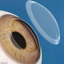 زرع العدسات اللاصقة لتصحيح النظر